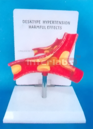 DSKTYPE (HYPERTENSION HARMFUL EFFECTS) DISEASE ARTERY WITH DESCRIPTION PLATE (A TYPE) 6.5 x 11.5 x 16.5cm